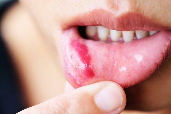 What To Do For A Blood Blister In Your Mouth