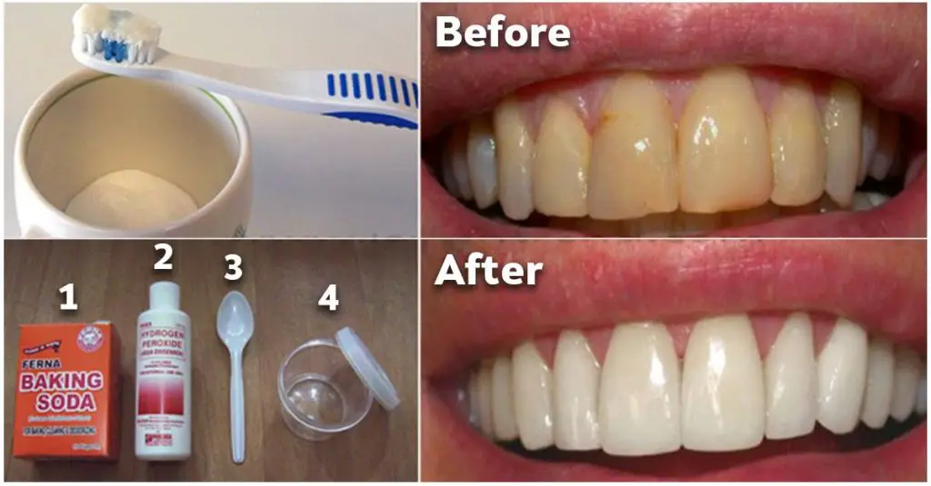 How To Get Rid Of Plaque and Whiten Your Teeth Without Expensive ...