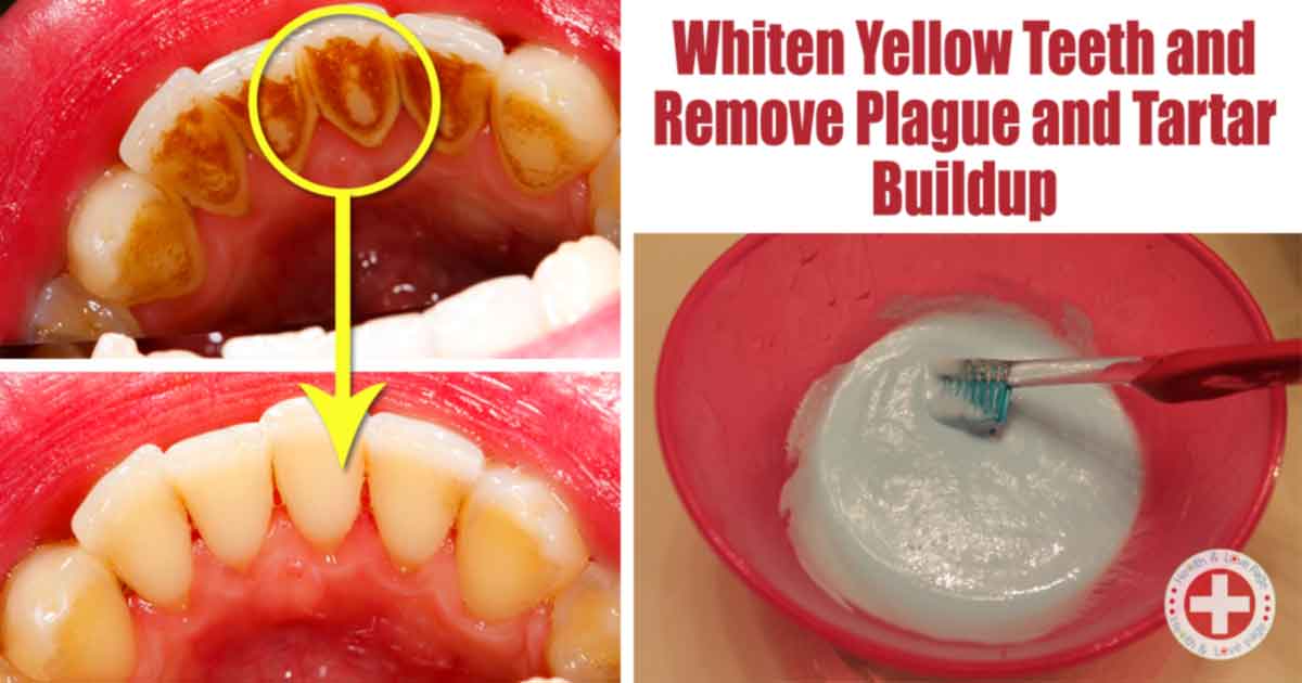 The Best Ways for Natural Teeth Plaque and Tartar Removal 99easyrecipes