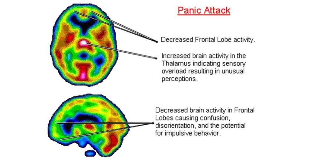 panic-attacks-and-anxiety-linked-to-low-vitamin-b6-and-iron-levels